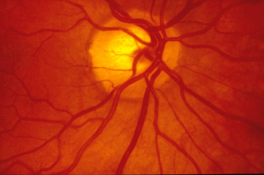 Colour photograph of the retina showing the optic disc and retinal blood vessels